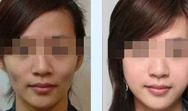 綿陽哪家醫(yī)院做雙眼皮效果好 綿陽哪家醫(yī)院做雙眼皮效果好