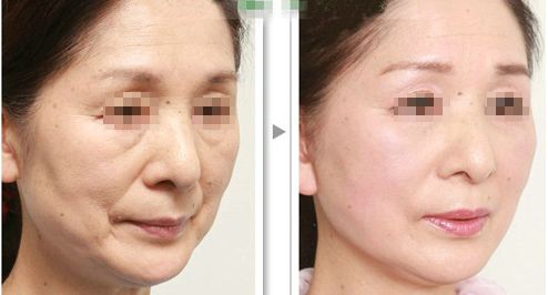 上海哪家磨骨醫(yī)院靠譜？華美、美聯(lián)臣、薇琳資歷雄厚值得信賴