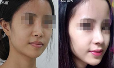 深圳哪家醫(yī)院隆胸效果好？排名前五火熱推薦！