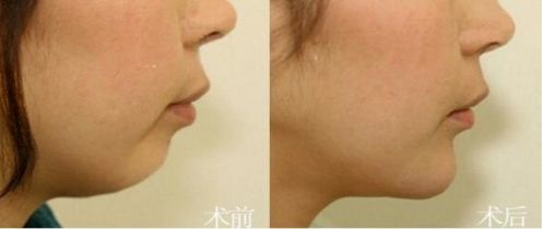 泉州最佳醫(yī)院推薦！一流技術(shù)與超高性價(jià)比，助您邁向完美美容整形！