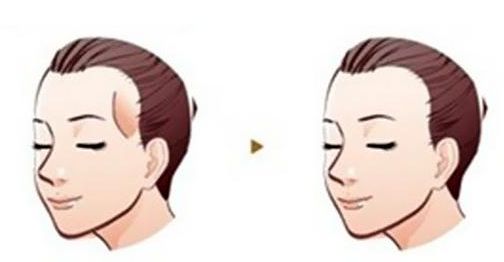癌癥患者的雙眼皮手術(shù)費(fèi)用分析及成功案例分享 癌癥患者的雙眼皮手術(shù)費(fèi)用分析及成功案例分享