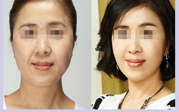 江西哪家鼻修復(fù)口碑好 江西哪家鼻修復(fù)口碑好
