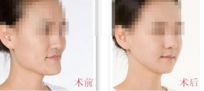 廣東省人民醫(yī)院美容科專家團隊與隆鼻手術(shù)揭秘 廣東省人民醫(yī)院美容科專家團隊與隆鼻手術(shù)揭秘