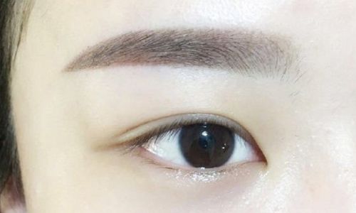 北京郭建玲雙眼皮手術(shù)費(fèi)用是否昂貴？醫(yī)生案例分享全面解析