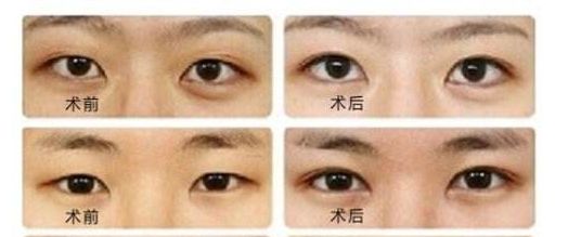 菲塑美減肥針：效果評(píng)估、價(jià)格和潛在風(fēng)險(xiǎn)全解析