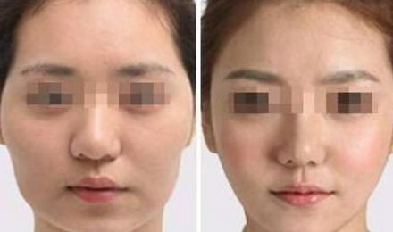 揭秘北京東方和諧脂肪填充真容，真實案例展示精湛技藝！