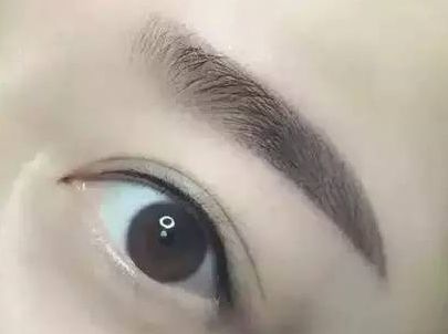 蘇州圣愛醫(yī)院整形科：90天變化揭示，雙眼皮驚喜盡顯！