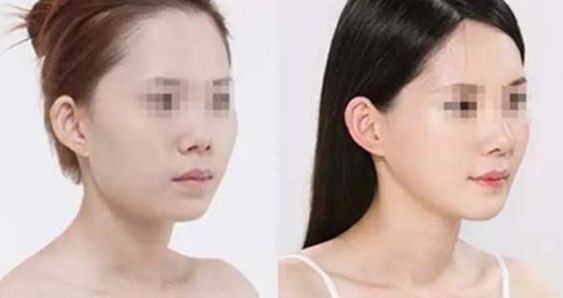 石家莊哪家整形醫(yī)院在隆鼻方面有口碑？