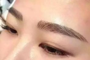 絕佳效果！體驗(yàn)成都周維開刀雙眼皮的精彩案例
