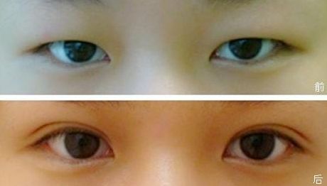 上海九院雙眼皮手術(shù)效果怎么樣？錢云良醫(yī)師的全新案例分享
