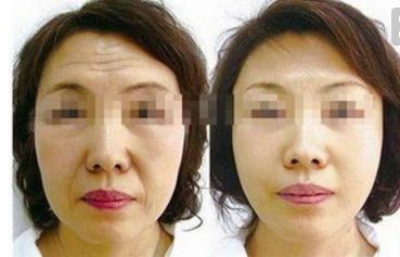 四川人民醫(yī)院王佳醫(yī)生提供下頜角整形案例，讓你輕松擁有小V臉