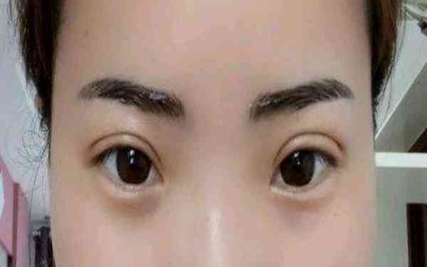 丁硯江填充脂肪的效果如何？為什么該方法備受推崇？