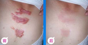 九院脂肪填充，醫(yī)生技術(shù)高超，詳細(xì)價(jià)格表揭曉