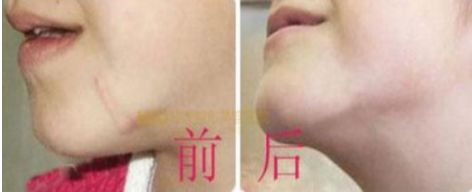 注射玻尿酸前需注意什么？用水清洗可否