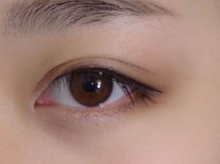 杭州任東做鼻部整容效果如何？MD技術(shù)解析真實(shí)案例分享！