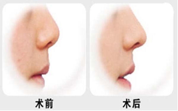 燕雄鼻子整容結(jié)果亮相！專家實(shí)力和成功案例揭秘