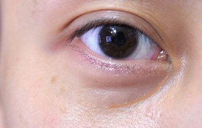 重慶美萊鄭楠醫(yī)生眼部整形術(shù)情況、資料及價格請參考