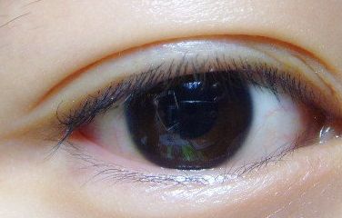 健麗整形醫(yī)院的去眼袋效果如何？2023患者分享案例！