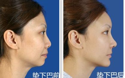 上海九院鼻部整形手術(shù)專家李圣利，專業(yè)水準(zhǔn)如何？