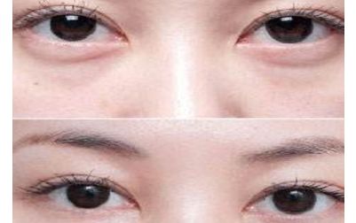北京張笑天的下頜角手術(shù)技術(shù)及豐碩成果曝光！醫(yī)術(shù)精湛，案例展示震撼人心