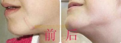 上海哪家醫(yī)院有專業(yè)的唇裂手術(shù)醫(yī)生？治療兔唇患者的必備信息！