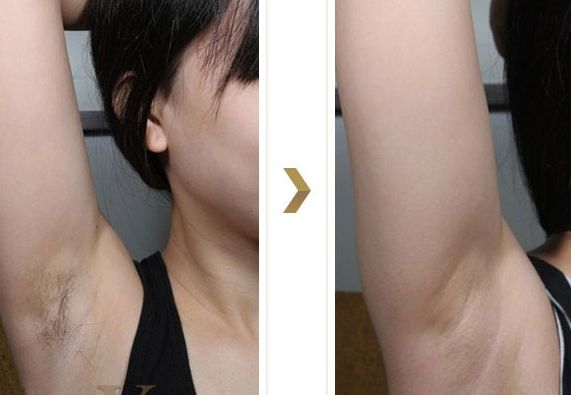 長(zhǎng)沙湘雅醫(yī)院的減肥科如何？大腿吸脂效果如何？