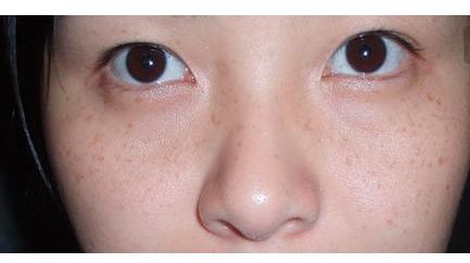張恒術(shù)雙眼皮手術(shù)80天后效果揭曉，驚喜呈現(xiàn)！