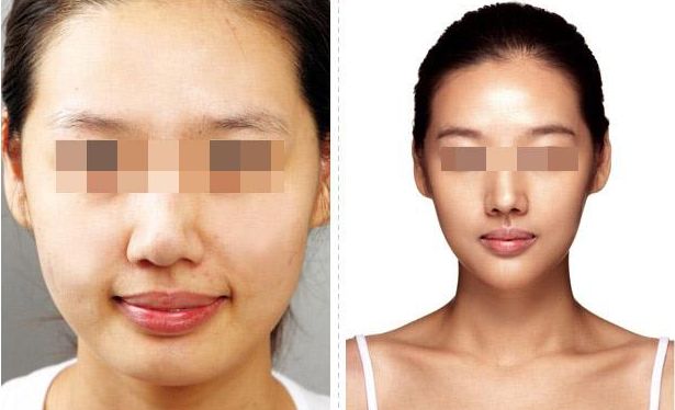 武漢恩娜整形中心：解讀雙眼皮手術(shù)全攻略，案例展示讓你真實了解效果！