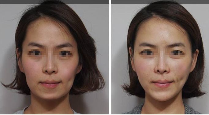 深圳頂級乳房整形專家團隊？權威醫(yī)院解答哪家三甲醫(yī)院最適合隆胸