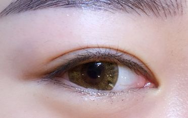 鄒翀，這一雙眼皮技術，近期有所革新