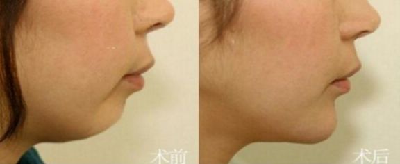 成都這7家專(zhuān)業(yè)豐胸醫(yī)院，不可錯(cuò)過(guò)的排名第一
