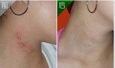 廣州隆胸手術(shù)費(fèi)用及案例分享，口碑如何？