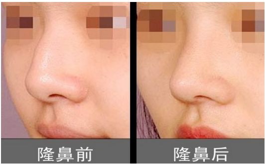 上海柴云醫(yī)生雙眼整形效果完美！手術(shù)前后真實(shí)照片呈現(xiàn)出專業(yè)水平