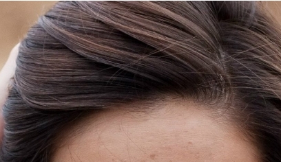 南昌二附院整形科眼袋抽脂效果好嗎？值得醫(yī)生推薦嗎？