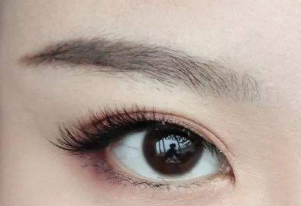 大連王琳雙眼皮的完美實(shí)踐，80天親身體驗(yàn)揭秘