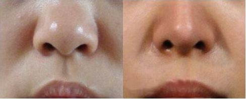 南京哪個醫(yī)生擅長縮胸手術(shù)？評價(jià)吳國平和金院長的技術(shù)