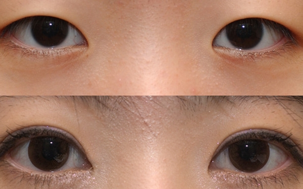上海哪家醫(yī)院做眼袋手術(shù)價格實惠又靠譜？排行榜前十強！