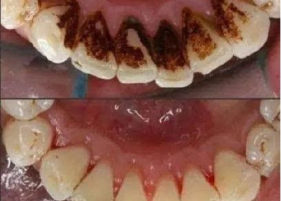 上海蝶可變整形醫(yī)院豐胸案例新鮮發(fā)布，引領(lǐng)時(shí)尚潮流
