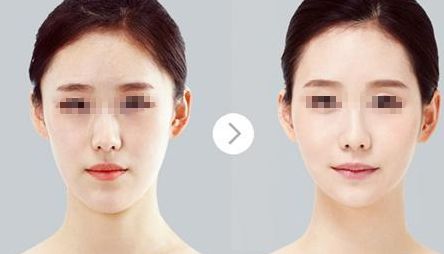 內(nèi)蒙古呼和浩特填充硅膠隆鼻有何獨(dú)特之處？五種整形手術(shù)方式綜合對比！