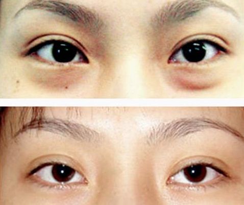 謝錦清：醫(yī)術(shù)高超，雙眼皮案例解析曝光！