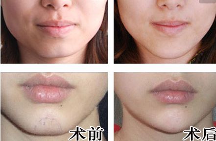 廣州人中縮短手術(shù)醫(yī)生推薦？網(wǎng)友真實(shí)評(píng)價(jià)與信息公開！