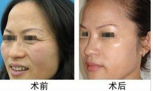 常見需要整形的手術(shù)嘴唇類型 常見需要整形的手術(shù)嘴唇類型