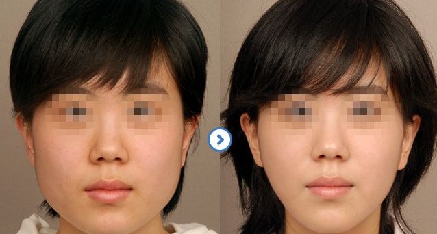成都隆鼻醫(yī)生排行榜2024：專家推薦的醫(yī)院大揭秘！