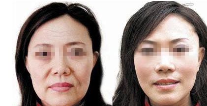 成都自然雙眼皮去哪家醫(yī)院靠譜？