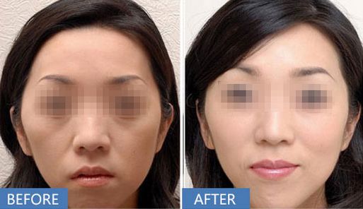 上海哪家醫(yī)院做打玻尿酸除皺效果好？