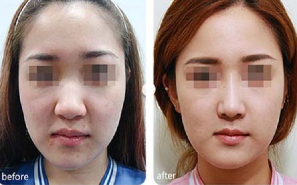 珠海市三家最受歡迎的隆鼻整形醫(yī)院及排名+推薦 珠海市三家最受歡迎的隆鼻整形醫(yī)院及排名+推薦