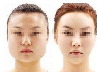 告別痘痘困擾，打造光彩肌膚