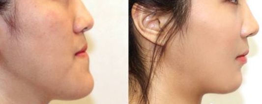 南京施爾美醫(yī)院醫(yī)生案例對比，讓你信服！