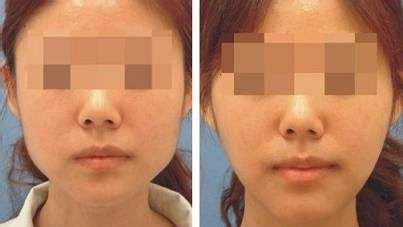 上海哪家醫(yī)院的下巴隆鼻手術(shù)效果最好？