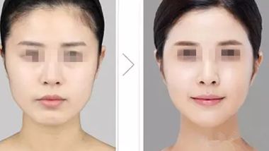 長沙雙眼皮整形醫(yī)院推薦，哪家效果更好？